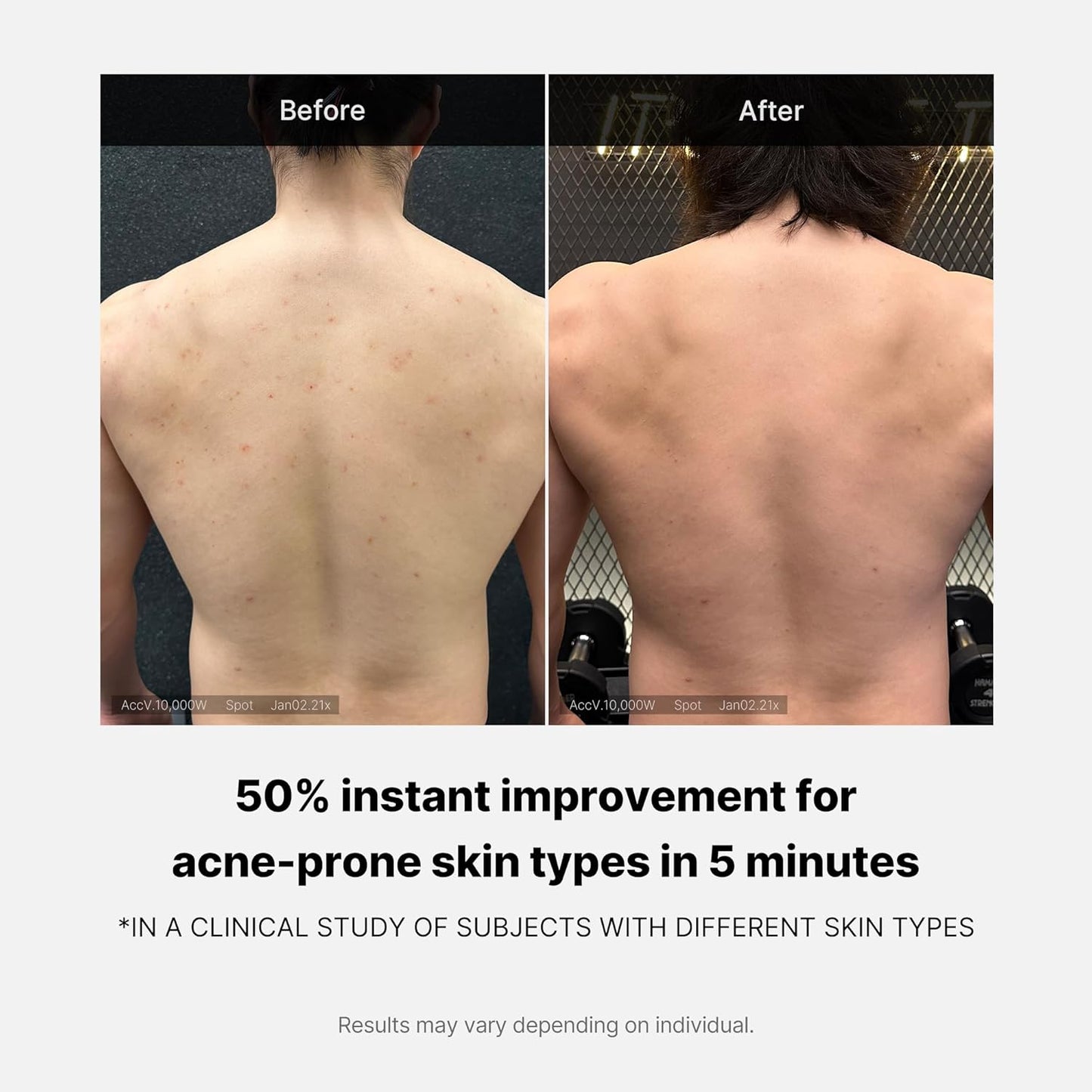 RED ACNE BODY WASH 2.0