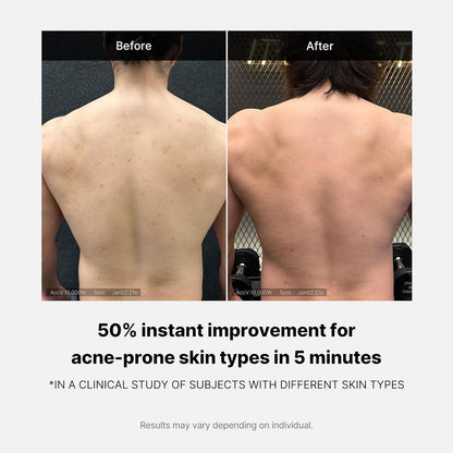 RED ACNE BODY WASH 2.0